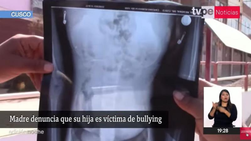 Cusco: menor hospitalizada tras ingerir una grapa en el colegio