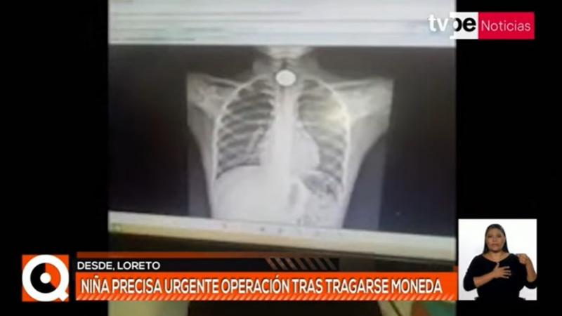 Loreto: niña tuvo que ser operada luego de ingerir una moneda de un sol