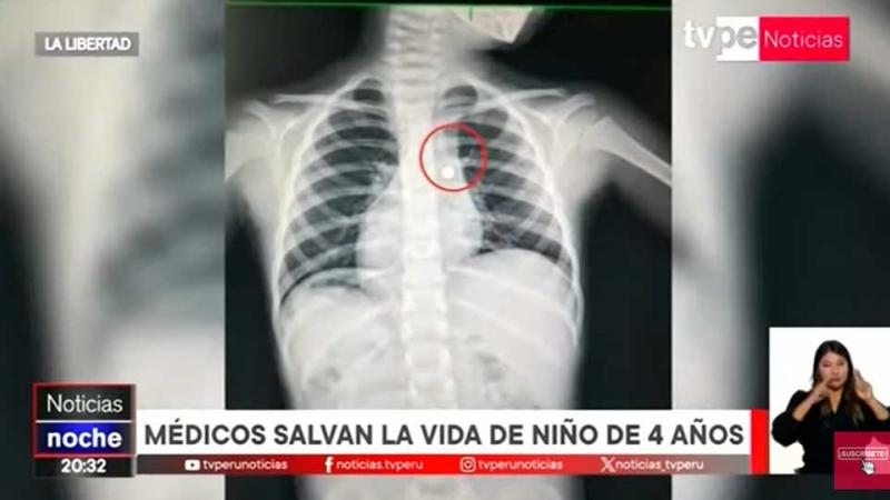 La Libertad médicos  niño  ingirió una pila