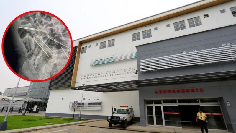 médicos salvan a niño que ingirió agujas 