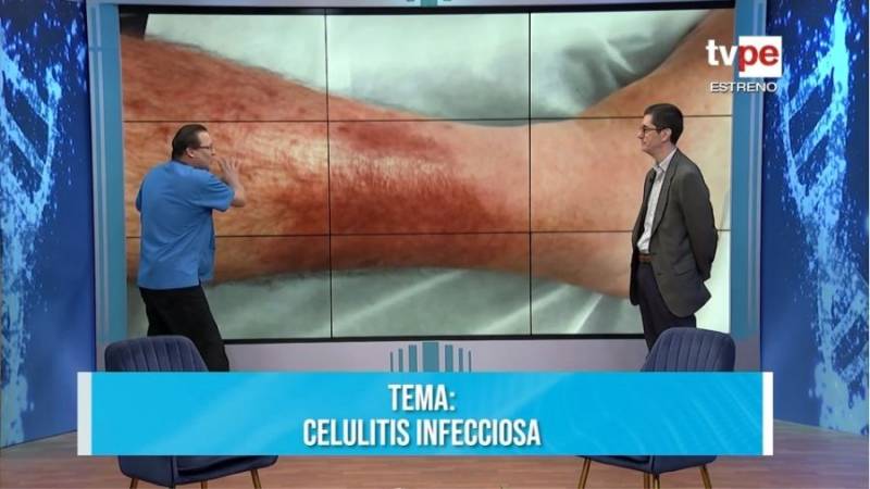 Celulitis