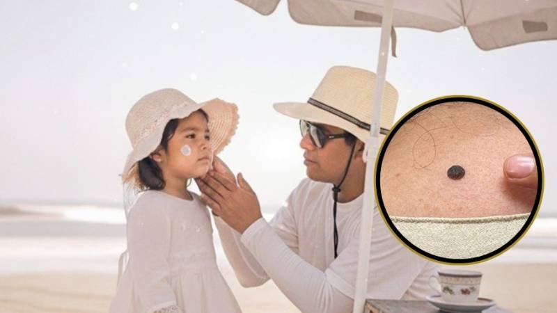 Minsa piel radiación solar